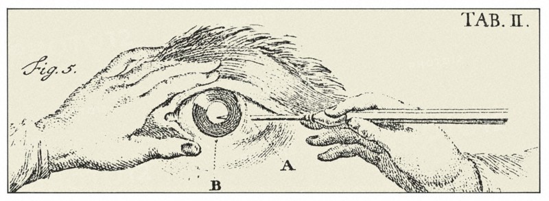 Engraving representing an eye surgery