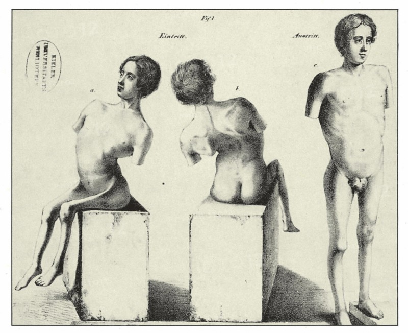 Enfants paraplégiques