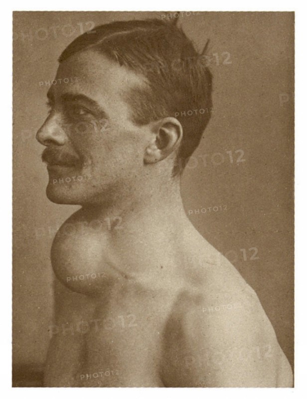 A man suffering from Grave's disease (exophtalmic goitre)