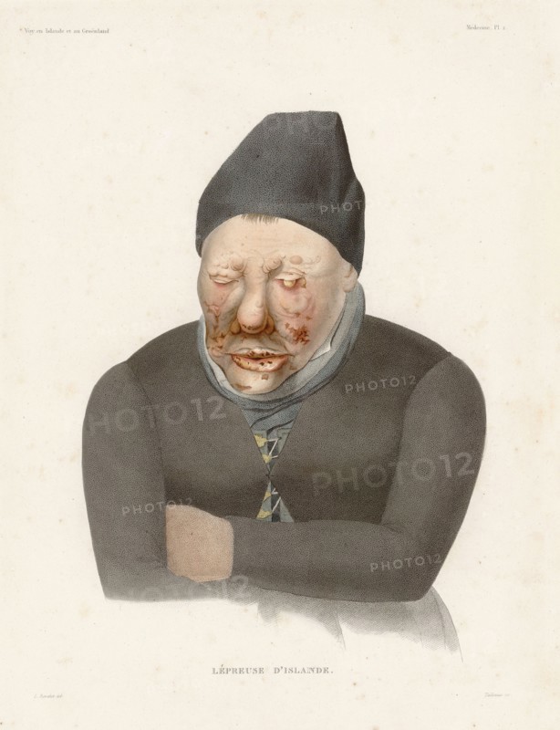 Sick with leprosy, 1835