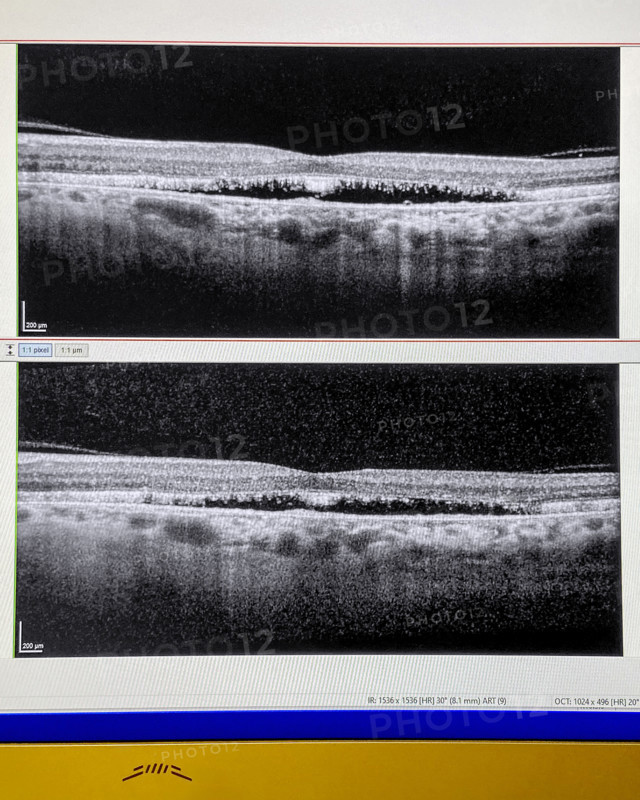 OCT scan (Optical Coherence Tomography) of human retina, both eyes