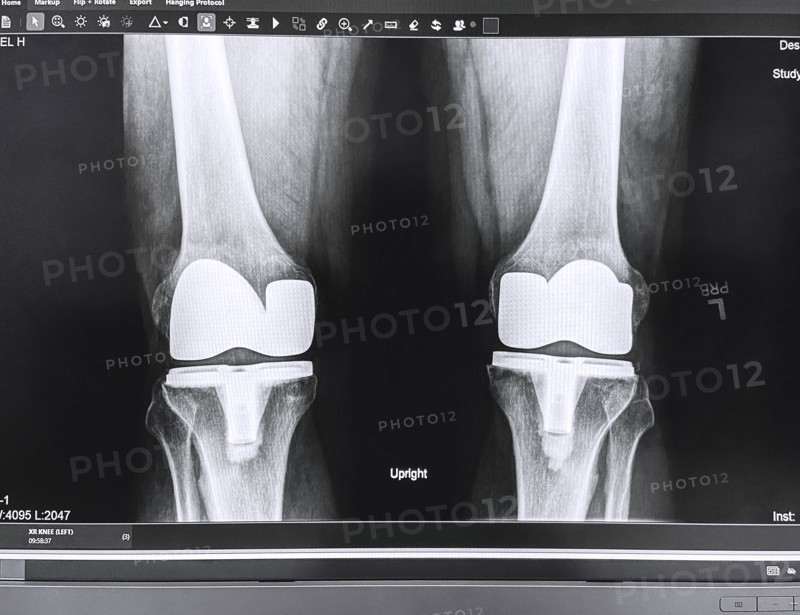 X-ray of adult man's knees after knee replacement surgery