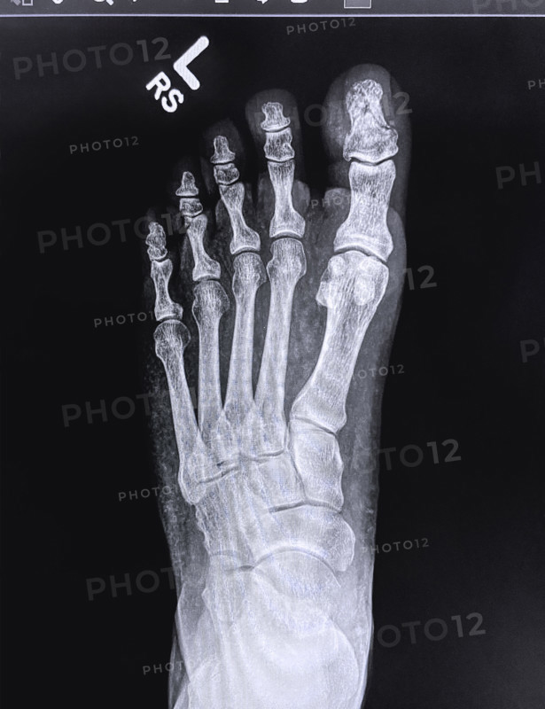 X-ray of broken toe on left foot