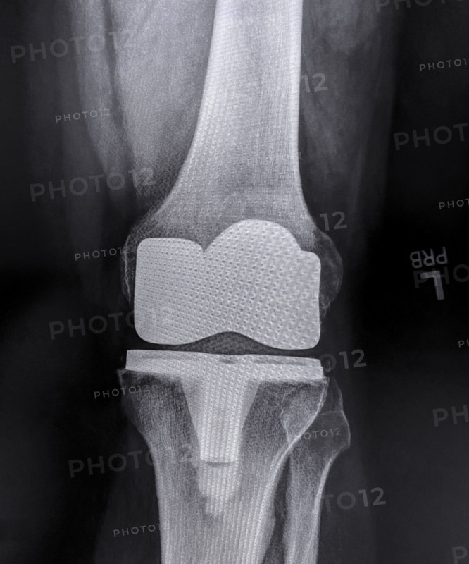 X-ray of adult man's left knee after knee replacement surgery