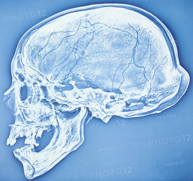 Xeroradiograph of the bathrocranic skull. Artist: Unknown