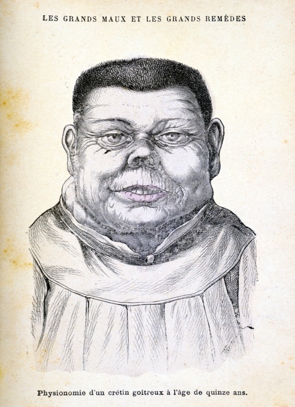 Cretin aged 15, c1890. Artist: Unknown