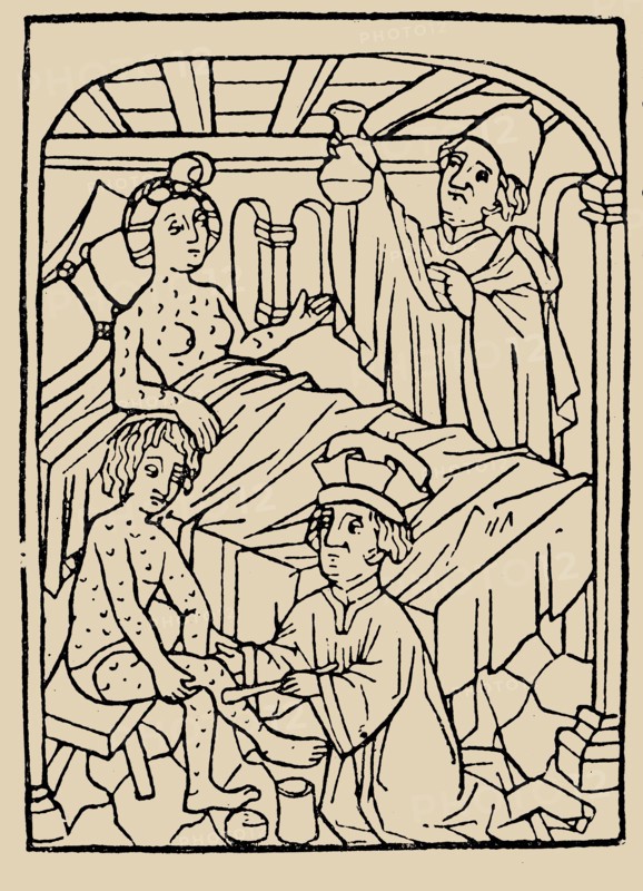 Syphilis treatment: Treatment with ointments (mercury). From: A Malafranczos morbo gallorum preserv