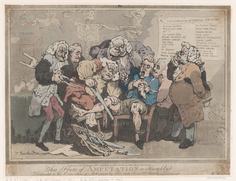 Amputation, February 17, 1786.