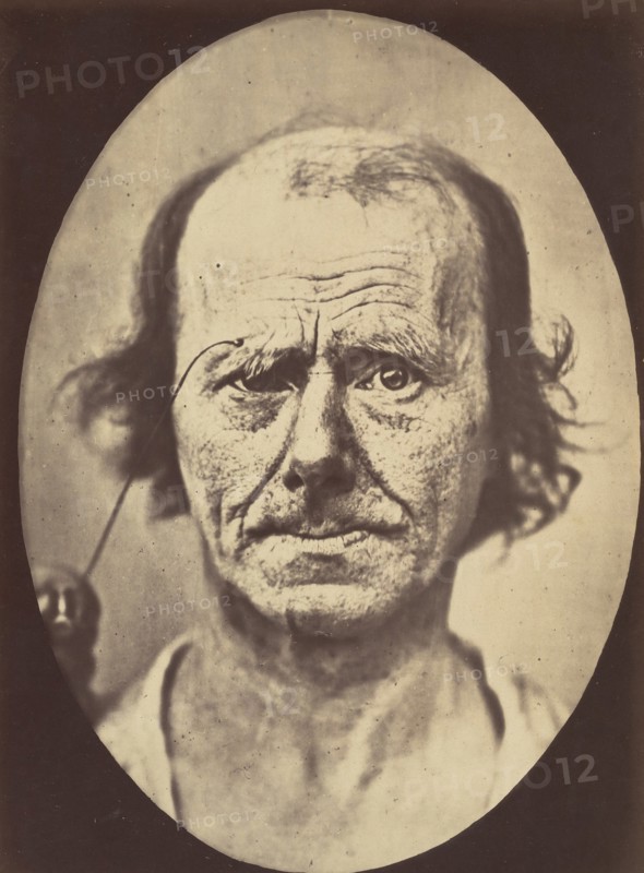 Figure 12: A study of the contraction of and the expression produced by the superior part of m. orbicularis oculi , 1854-56, printed 1862.