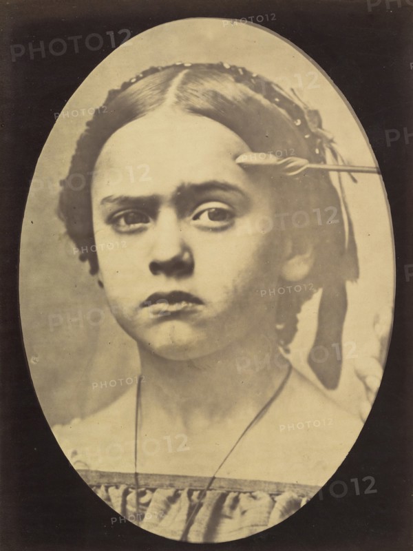 Figure 10: Showing the expressive lines of m. frontalis in a young girl , 1854-56, printed 1862.