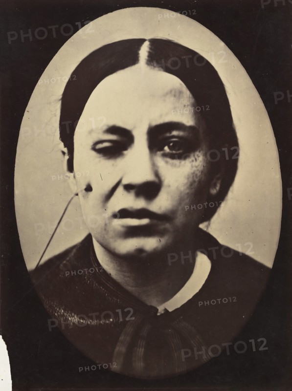 Figure 50: Affected weeping and face in repose, 1854-56, printed 1862.