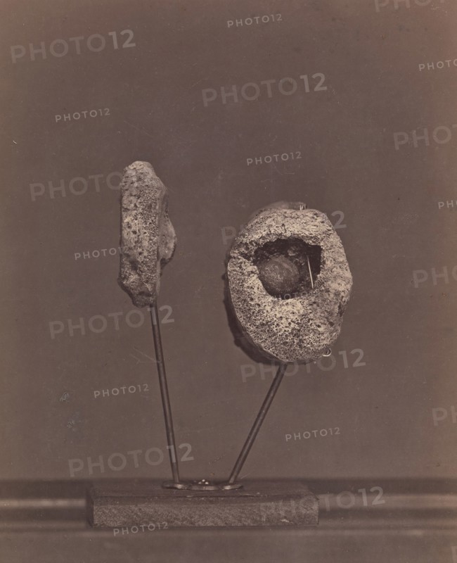 Excised Knee Joint. A Round Musket Ball in the Inner Condyle of the Right Femur [Gardiner Lewis, Company B, Nineteenth Indiana Volunteers], 1866-67.