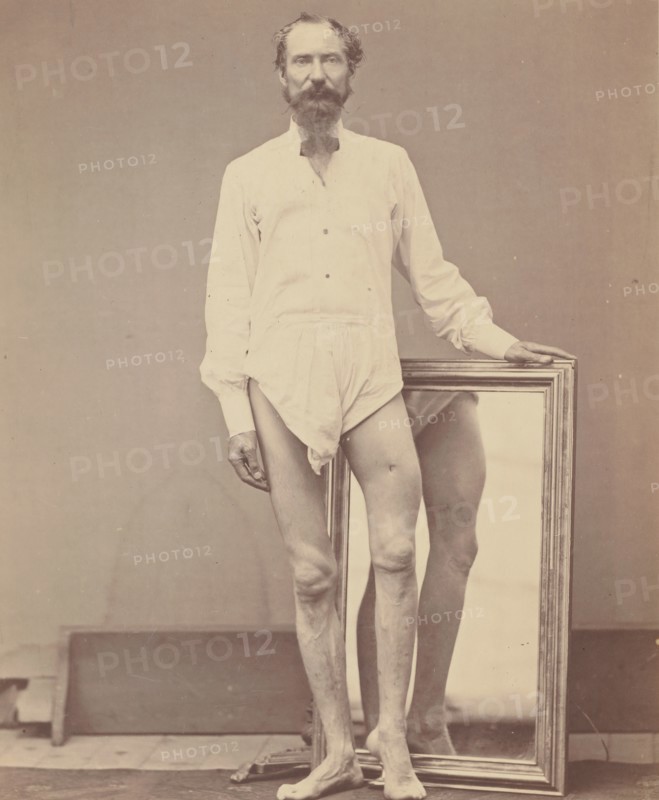 Gunshot Wound of Middle Third of Left Femur, 1865-67.