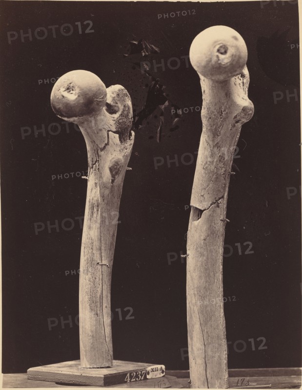 Specimens of Gunshot Fractures of the Femur, c. 1867.