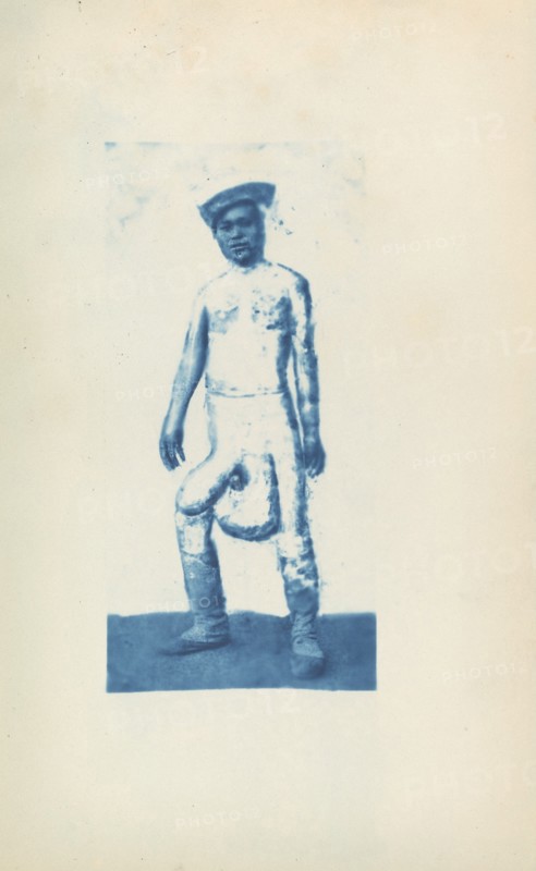 Elephantiasis, c. 1870s.