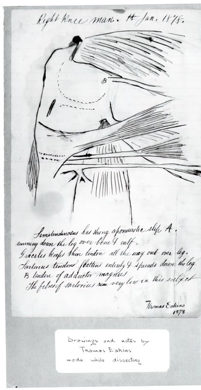(Untitled) (Anatomical Study Of Right Knee), 1878.