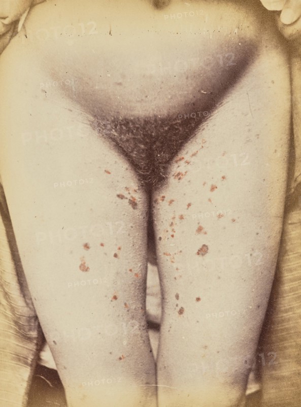 Syphilide, 1871. Creator: Arthur de Montmeja.