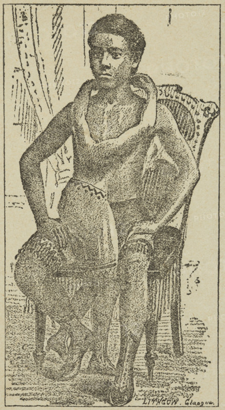 Lalloo, The Greatest Living Wonder on Earth, 1887. Illustration from an advertisement for the Nottingham Goose Fair in October 1887. The text of the poster states that Lalloo "is possessed of two bodies, one head, four perfect arms, four perfect hands, four perfect legs, four perfect feet. But Lalloo has only got one perfect head." Lalloo, from Lucknow in India, was likely born with polymelia, where an individual has more than the usual number of limbs.