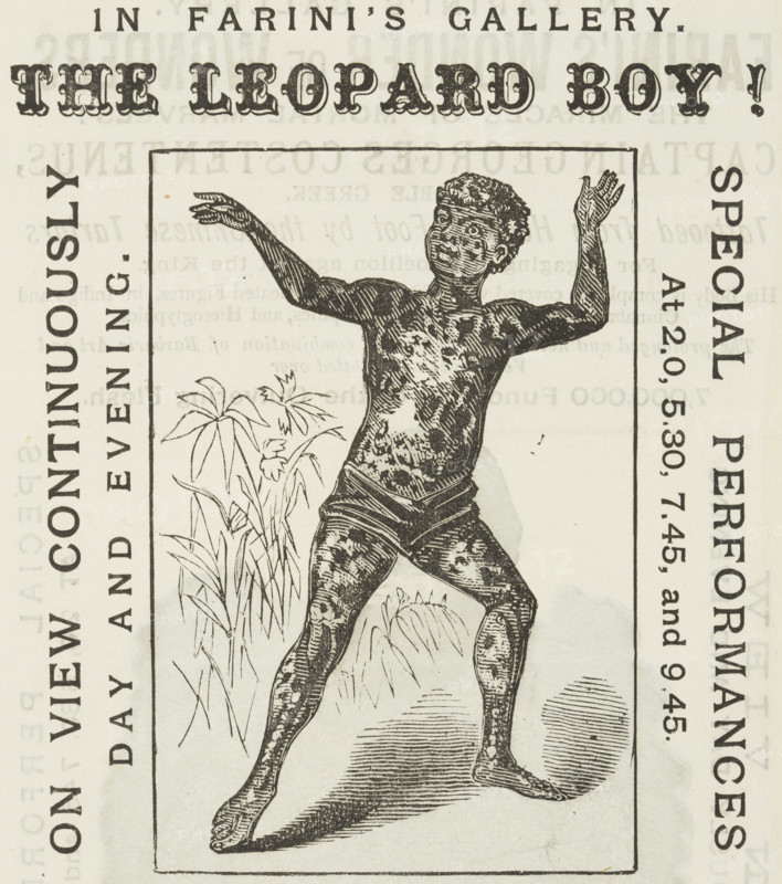 The Leopard Boy! in Farini's Gallery, 1881. 'On View Continuously, Day and Evening. Spotted black, white and yellow from head to foot'. Child with some sort of skin condition, 'performing' in Farini's World of Wonders Gallery at the Royal Aquarium in London. Showmanship was a hard business. People and animals with unusual characteristics were ruthlessly exploited and there was little care for them once they lost their popularity with the audience.