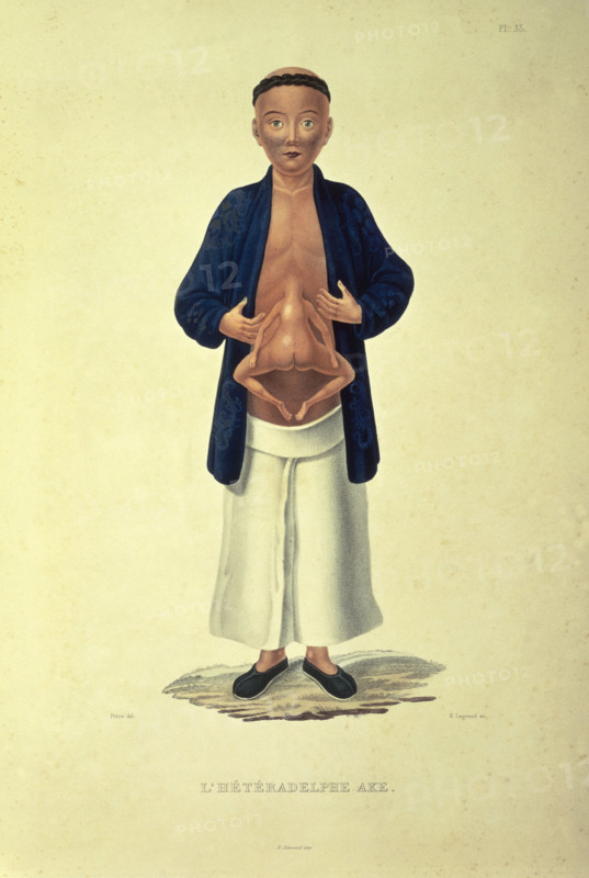 L'heteradelphe Ake, c1824-c1826. A human figure with a body growing from the stomach. The term heteradelph meant double-bodied. From "Journal de la navigation autour du globe de la fregate la Thetis et de la corvette l'Esperance" (Journal of the navigation around the globe of the frigate Thetis and the corvette Esperance) by Hyacinthe de Bougainville.