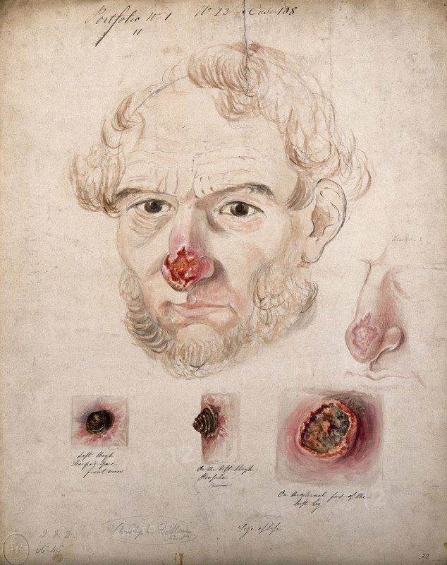 Head of a man with a severe disease affecting his nose; a detail of the nose..., 1800-1899. Creator: Christopher D'Alton.