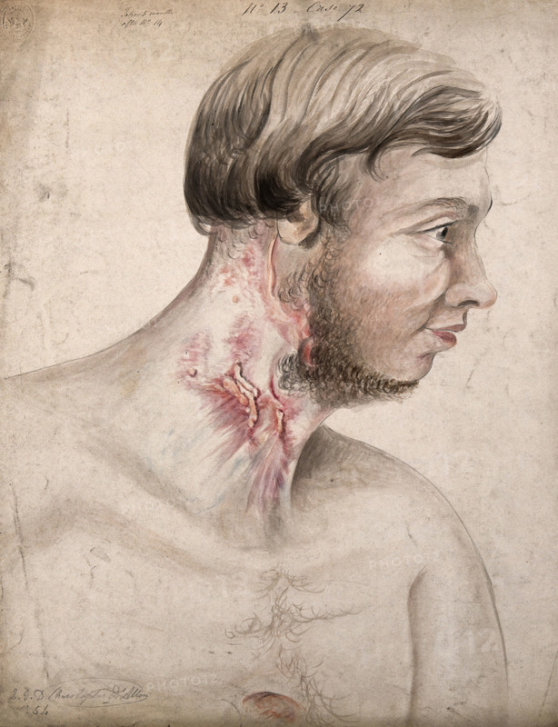 Head and chest of a man with a disease affecting his neck, seen in profile, 1856. Creator: Christopher D'Alton.