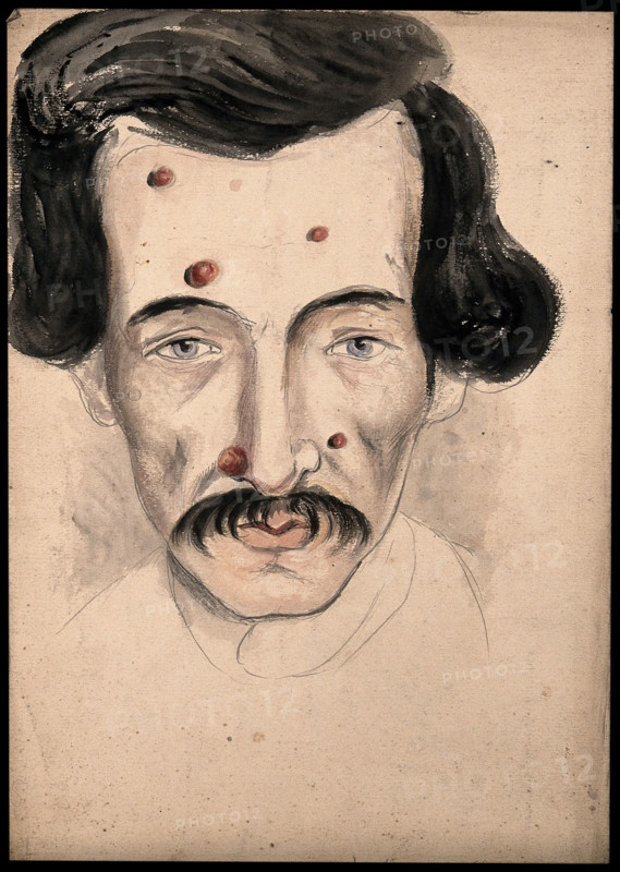 Head of a man with a disease affecting his face, 1800-1899. Creator: Christopher D'Alton.