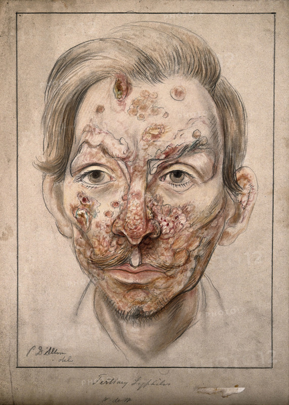 Head of a man with a syphilitic lesions affecting his face, 1874. Creator: Christopher D'Alton.