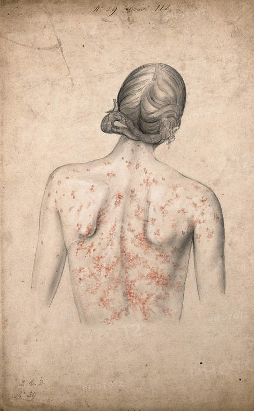 Back of a woman suffering from a rash of sores, 1855. Creator: Christopher D'Alton.