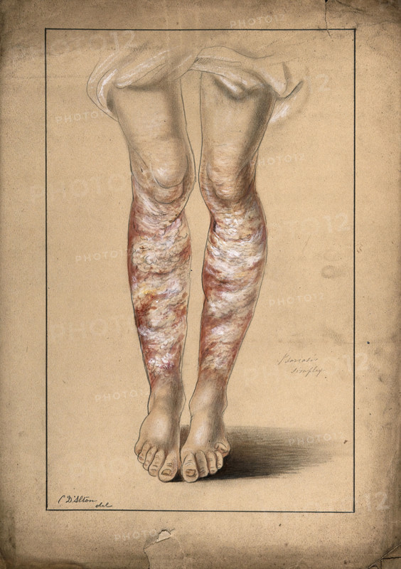 Diseased skin on the legs of a man suffering from psoriasis, 1873. Creator: Christopher D'Alton.