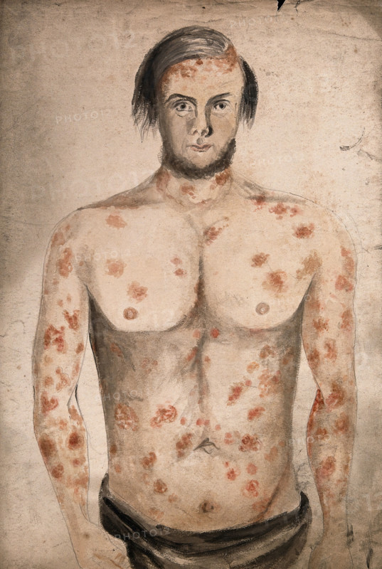 The face, arms and torso of a man suffering from diseased skin and abcesses (?), between 1800 & 1899 Creator: Christopher D'Alton.