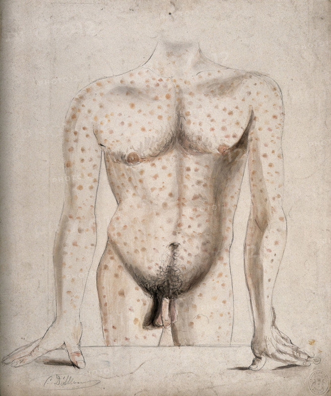 The torso, arms and upper thighs of a man suffering from a rash of sores, (1853?). Creator: Christopher D'Alton.