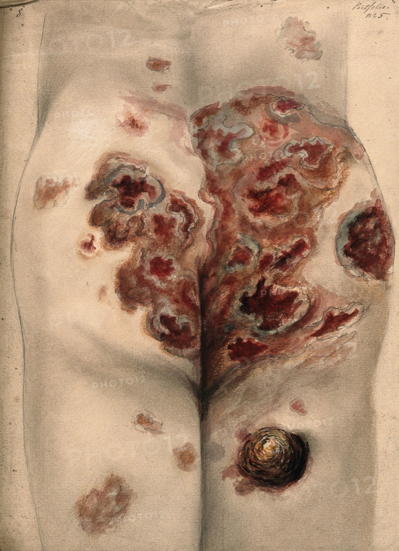 Severely diseased tissue on the buttocks and thighs of a man, 1867. Creator: Christopher D'Alton.