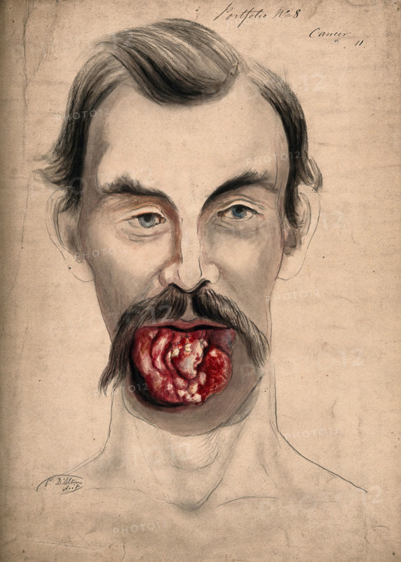 The face of a man suffering from cancer of the tongue, showing severely diseased tissue..., 1867. Creator: Christopher D'Alton.