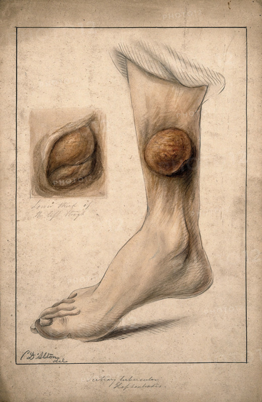 Tertiary tubercular elephantiasis on the thigh and calf of a woman, 1874. Creator: Christopher D'Alton.