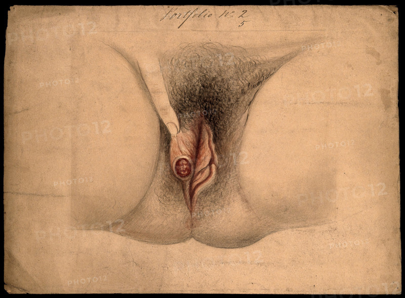 Female genitalia held open by a finger to show an area of diseased tissue, (18)66. Creator: Christopher D'Alton.