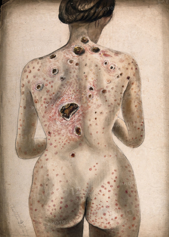 The back, buttocks and arms of a woman, displaying areas of diseased tissue..., (1840/1870?). Creator: Christopher D'Alton.