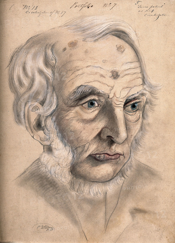 A man suffering from chancre of the lip, displaying scar tissue on his lower lip, forehead..., 1867. Creator: Christopher D'Alton.