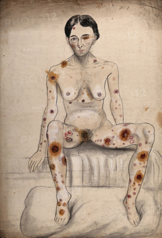 A seated woman displaying areas of diseased tissue on her entire body, face, genitals and eye, 1858. Creator: Christopher D'Alton.