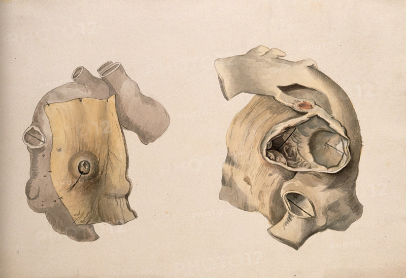 Two diseased parts of the body. Creator: Unknown.