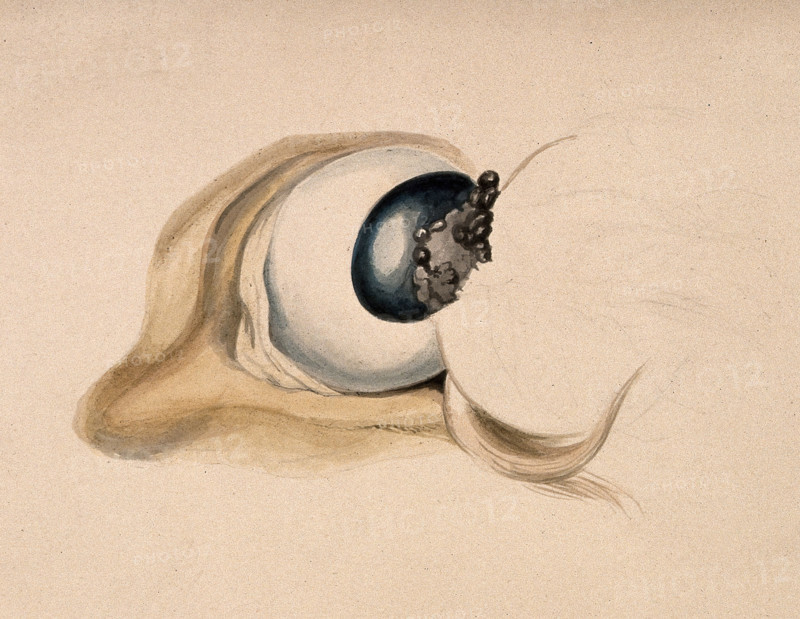A diseased eye. Creator: Unknown.
