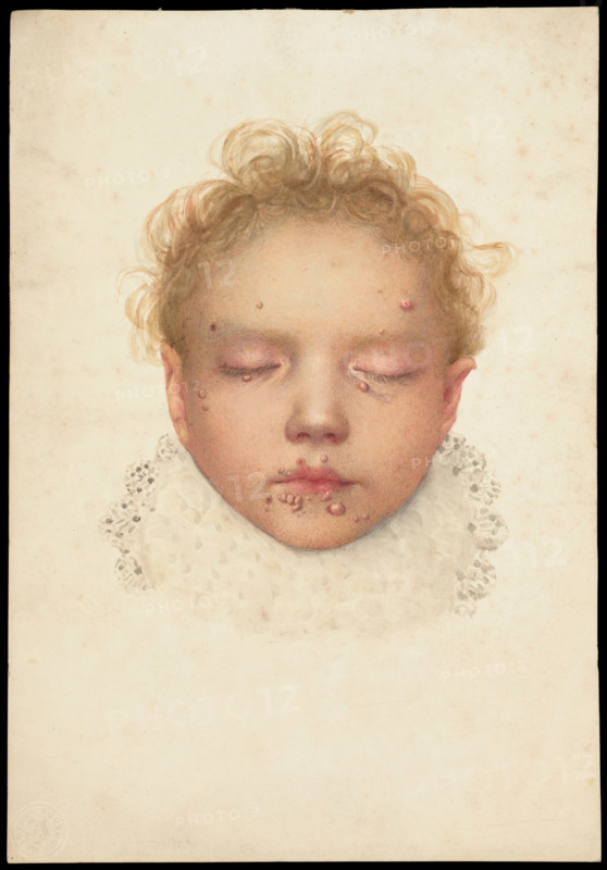 Head of a child with closed eyes and skin disease on the face, 1892. Creator: Unknown.