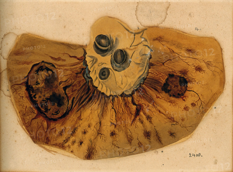 A section of diseased intestine or heart, 1800-1850. Creator: Richard Bright.