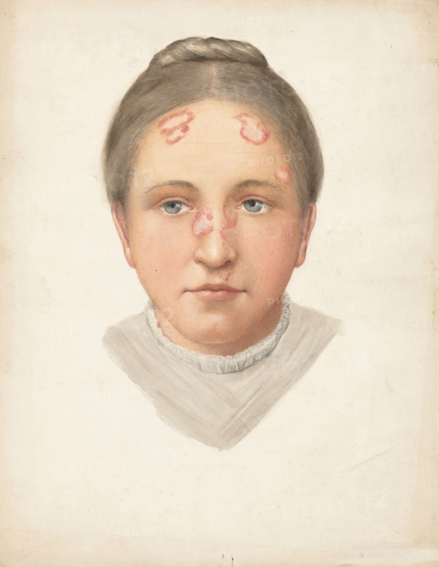 The head of a young woman with loss of skin on her forehead and nose, (1900?). Creator: Jonathan Hutchinson.