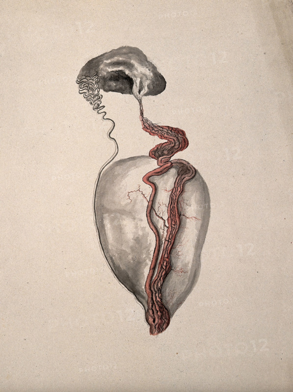 A diseased part of the body. Creator: Unknown.