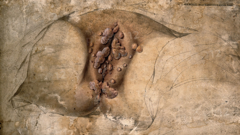 Female genitalia covered with syphilitic warts, c1824. Creator: Unknown.
