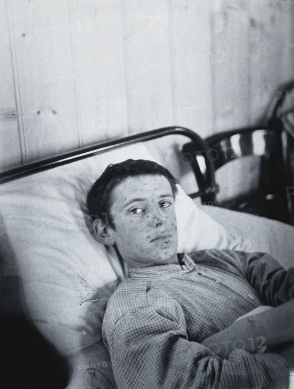 Gloucester smallpox epidemic, 1896: J  Mawson, a smallpox patient, 1896. Creator: HCF of Gloucester.