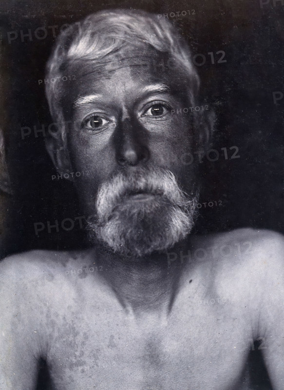 Friern Hospital, London: a patient, facing forwards, 1890/1910. Creator: Unknown.