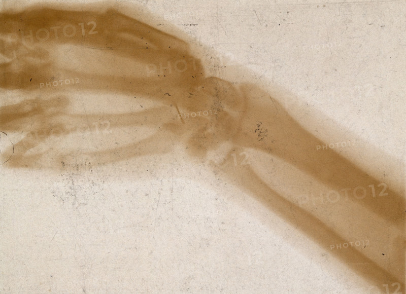 The bones of a hand and wrist, viewed through x-ray, 1896.
