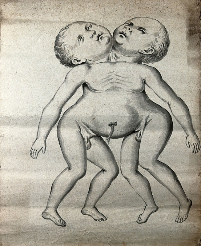 Male conjoined twins joined at the neck and chest; anterior view, 1900. Creator: Unknown.